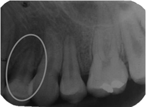Figura 21 Rx. periapical izquierda