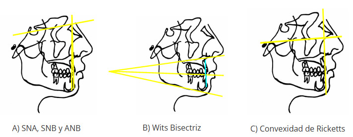 Figura 1. Determinación cefalométrica de relación maxilomandibular según, A)Steiner, B)Jacobson (Wits) y C)Ricketts.
