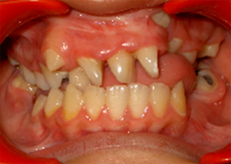 Foto 3. Intraoral de frente