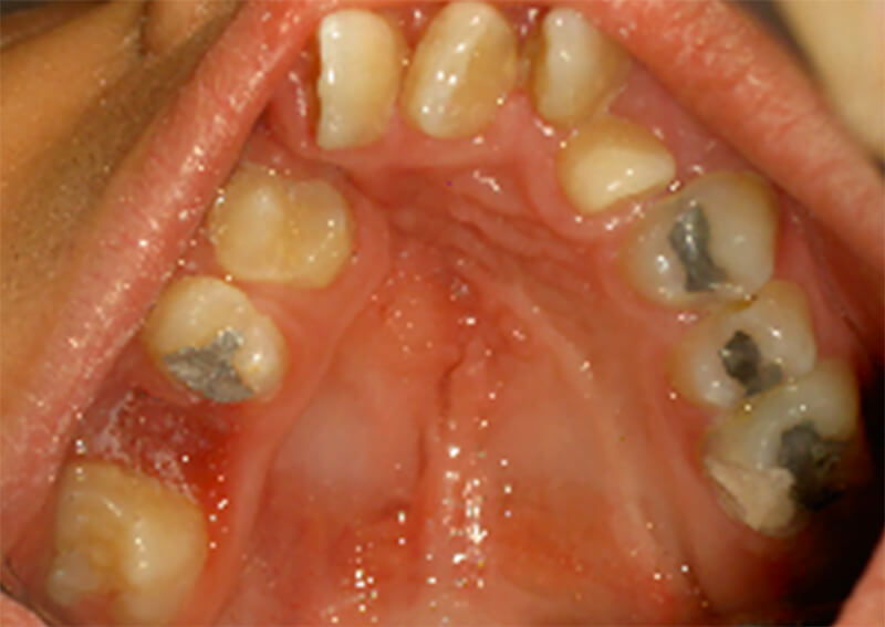 Foto 6. Oclusal superior