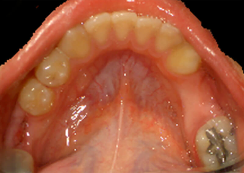 Foto 7. Oclusal inferior