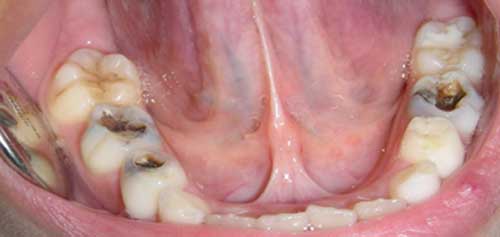 Anexo Nº 1: Caries Dental