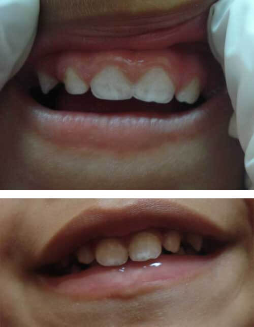 Anexo Nº 3: Hipoplasia del esmalte