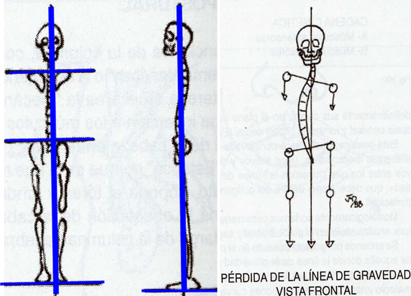 Fig. 1 ínea de gravedad. Tomada de Ohanian M., Fundamentos de la ortopedia dento-maxilo-facial.