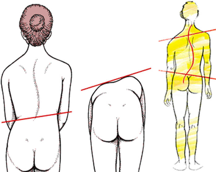Fig. 6 Desviaciones en la columna. Tomado de Quiropraxis y posturología. www.tripod.com
