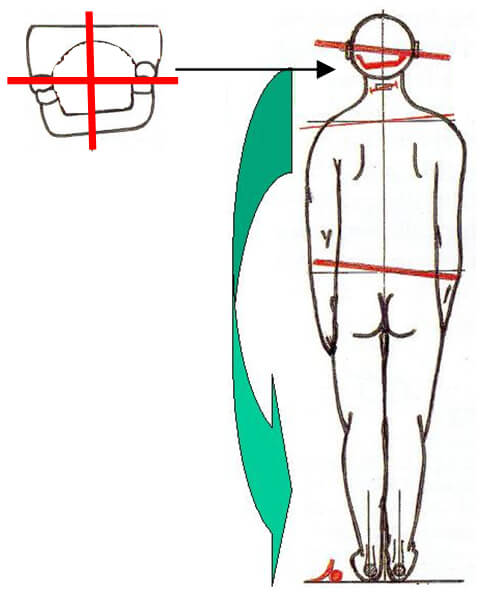 Fig 8 Síndrome postural descendente. Tomada Conferencia impartida en las 7ª Jornadas de Encuentro Pediatría Odontopediatría, España 2.006