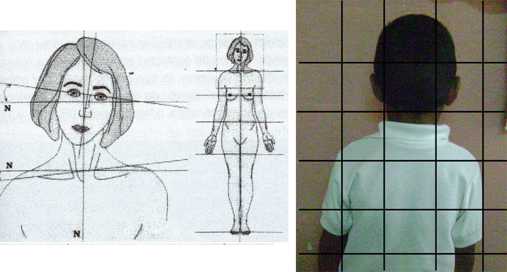 Fig.9 Inclinación de la cabeza hacia el lado afectado. Tomada de Ohanian M., Fundamentos de la ortopedia dento-maxilo-facial