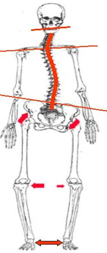 Fig.10 Síndrome postural ascendente Tomada Conferencia impartida en las 7ª Jornadas de Encuentro Pediatría Odontopediatría, España 2.006