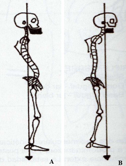 Fig.11. A – mesiorrelación / B – distorrelación. Tomada de Ohanian M.Fundamentos de la ortopedia dento-maxilo-facial