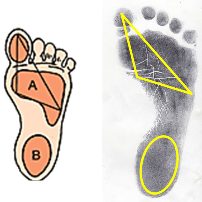 Fig. 12 Apoyo normal. (Fuente propia)