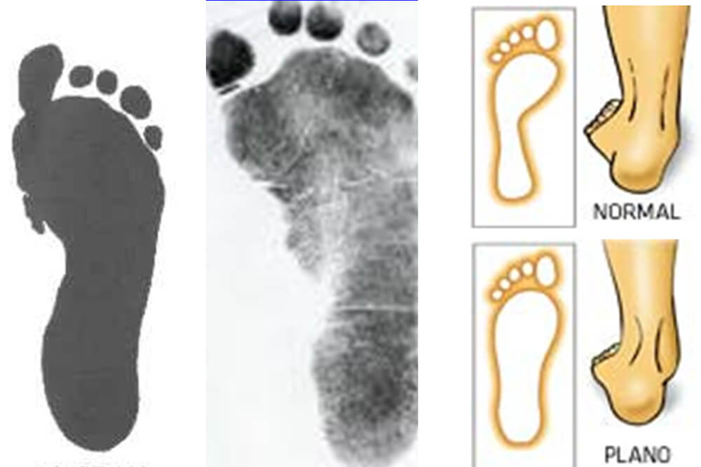 Fig.14 Pie plano grado 1 / Pie plano
