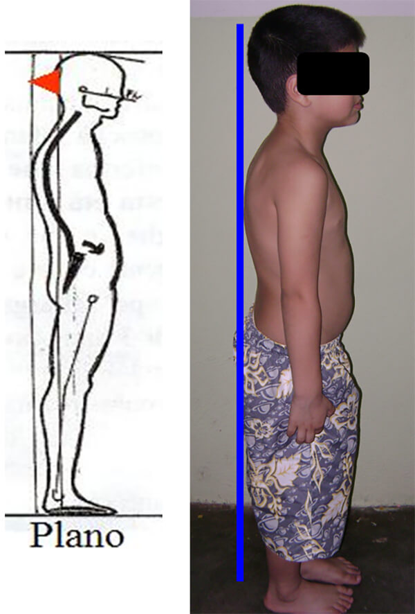 Fig.15 Niño con pie plano grado I y protrusión mandibular