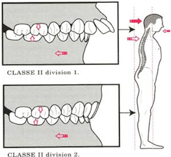 Fig.18 Postura de pacientes con clase II. Tomado de Tomada de Quiropraxis y posturología www.tripod.com