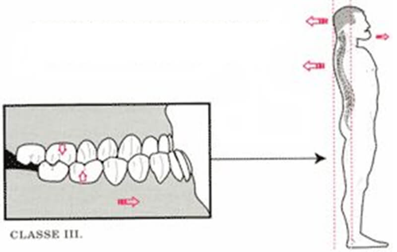 Fig.19. Postura de paciente con clase III de Angle. Tomada de Quiropraxis y posturología. www.tripod.com