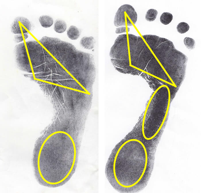 Zonas de apoyo plantar normal / zonas de apoyo plantar en paciente clase II