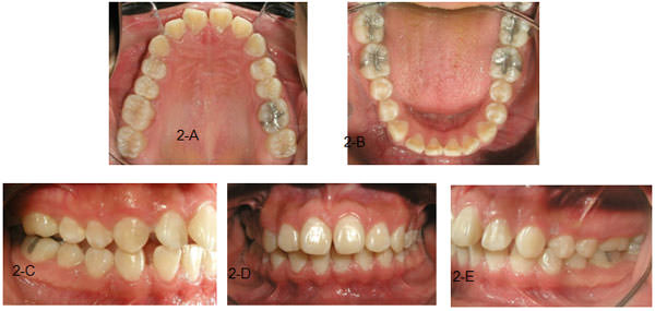 Figura 2 A oclusal superior, 2-B oclusal inferior, 2-C lateral derecha, 2-D de frente en oclusión céntrica, 2-E lateral izquierda.