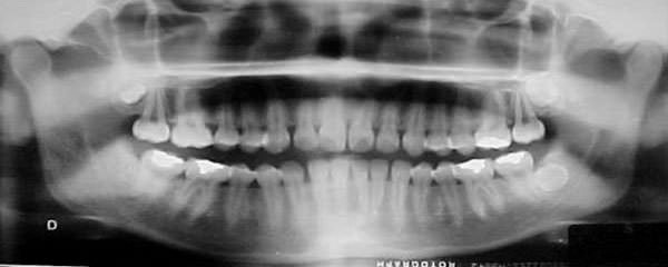 Figura 3 Radiografía panorámica inicial.