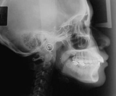 Figura 4 Radiografía cefálica lateral de inicio.