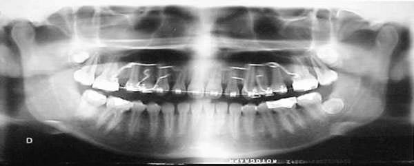 Figura 8 Radiografía panorámica de progreso