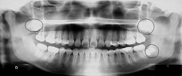 Figura 13 Radiografía Panorámica Final