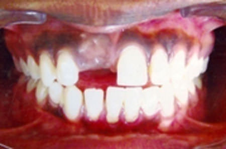Figure 1: Pre-treatment (A) Panoramic radiograph (B) Intraoral frontal photograph