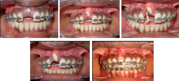 Figure 2: Mid-treatment (A) 0.019"×0.025" rectangular stainless steel arch wire (B) Surgical exposure and bonded beggs bracket (C) Elastic thread (D) Piggy back (D) Torquing auxillary