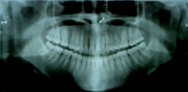 Figure 2 Post-treatment (A) Intraoral frontal photograph (B) Panoramic radiograph