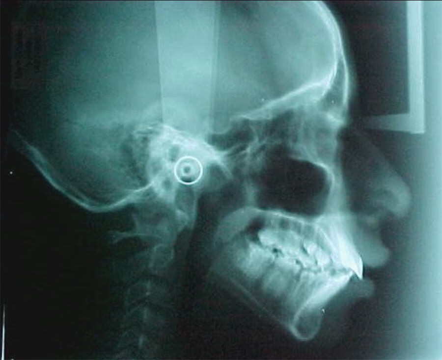 Figura 5 Radiografía lateral de cráneo inicial