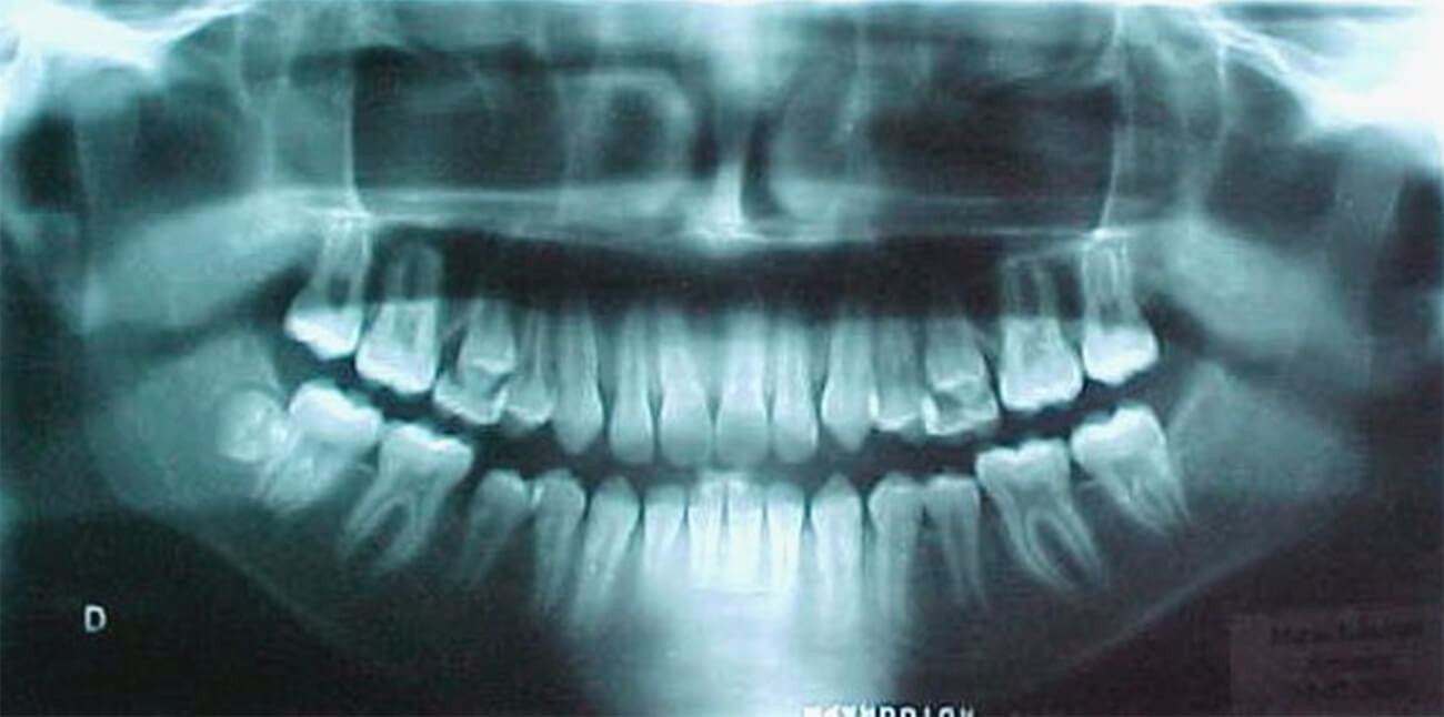 Figura 6 Radiografía Panorámica inicial