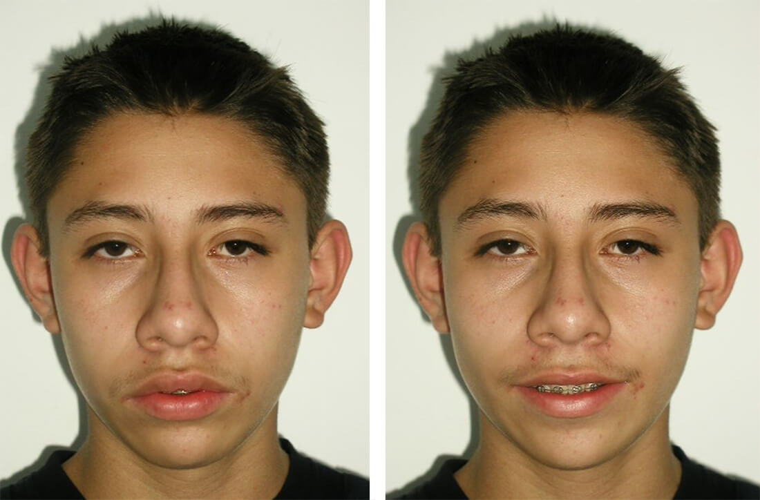 Figura 9 Frente progreso / Figura 10 sonrisa progreso