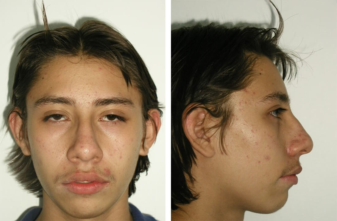 Figura 13 Frente final / Figura 14 Perfil final
