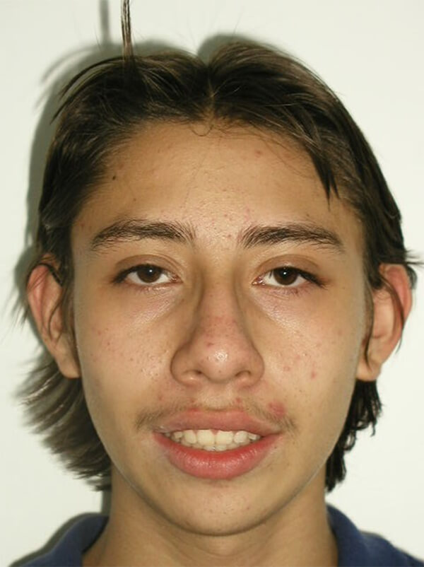 Figura 15 sonrisa final