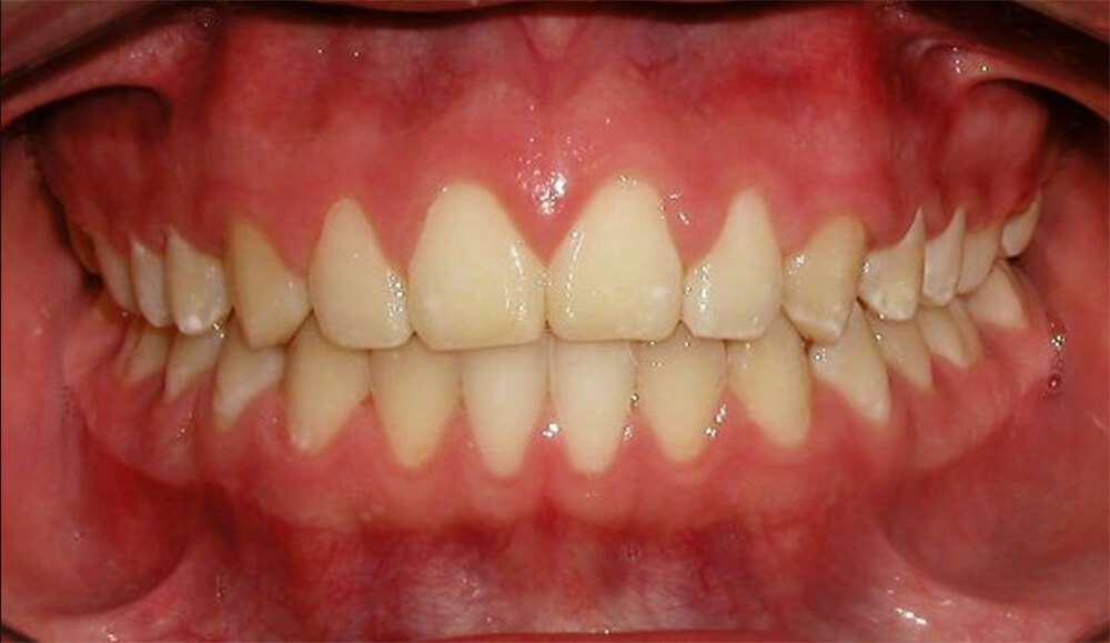 Figura 16 Intraoral final