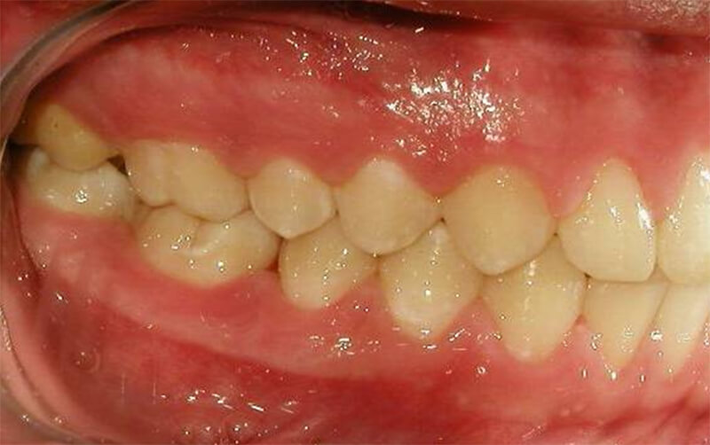 Figura 17 Intraoral derecha