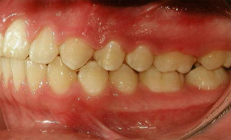 Figura 18 Intraoral izquierda