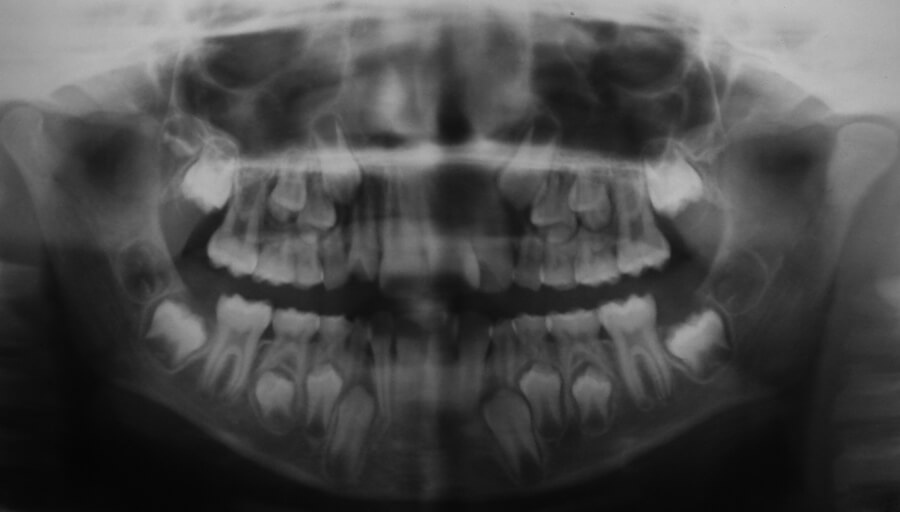 Radiografía Panorámica donde se observa el avance de los premolares sobre el caninos inferior (Alterada)