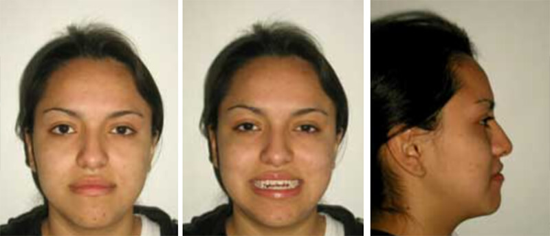 Fig 1 Fotografía de frente / Fig 2 Fotografía frente sonrisa / Fig 3 Fotografía perfil