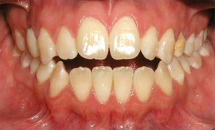 Fig.4 Fotografía oclusal de frente corrobora mordida abierta