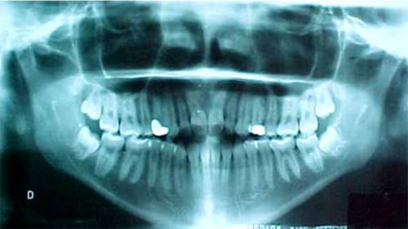 Fig.6 Radiografía panorámica, se observa la falta de contacto anterior
