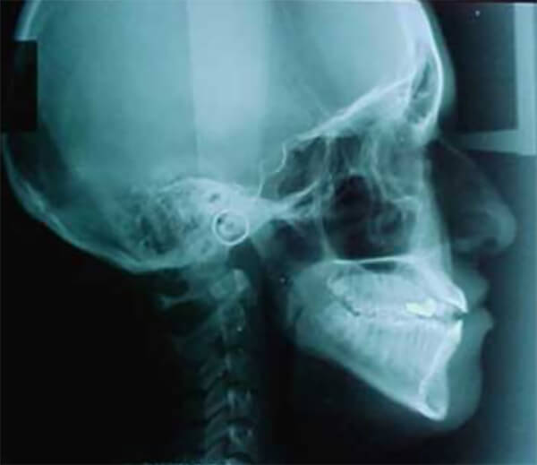 Fig. 7 Radiografía cefálica lateral. Se observa la hiperdivergencia de la paciente y la mordida abierta anterior