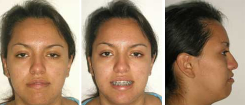 Fig. 8 Fotografía de frente progreso / Fig. 9 Fotografía de sonrisa progreso / Fig. 10 Foto lateral de progreso