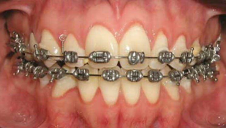 Fig. 11 Fotografía oclusal de frente