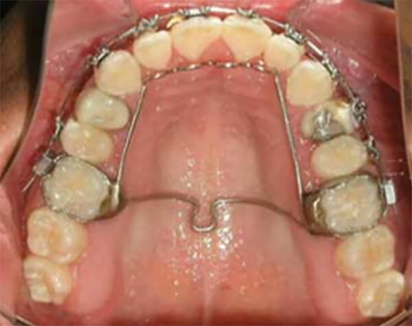 Fig. 12 Se muestra el corrector de hábitos conocido como trampa de lengua.