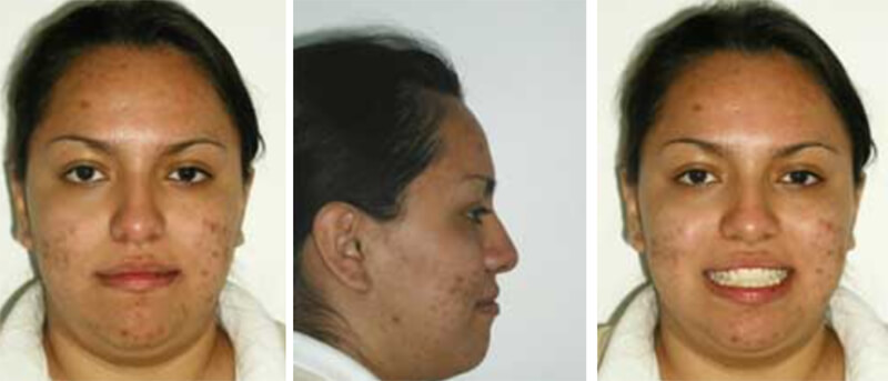 Fig. 13 Fotografía de frente final / Fig. 14 Fotografía de perfil final / Fig. 15 Fotografía de frente sonrisa final