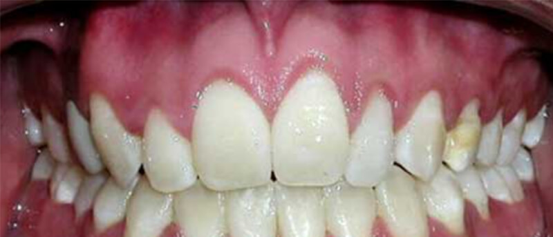 Fig. 16 Fotografia intraoral se observa la mordida cerrada