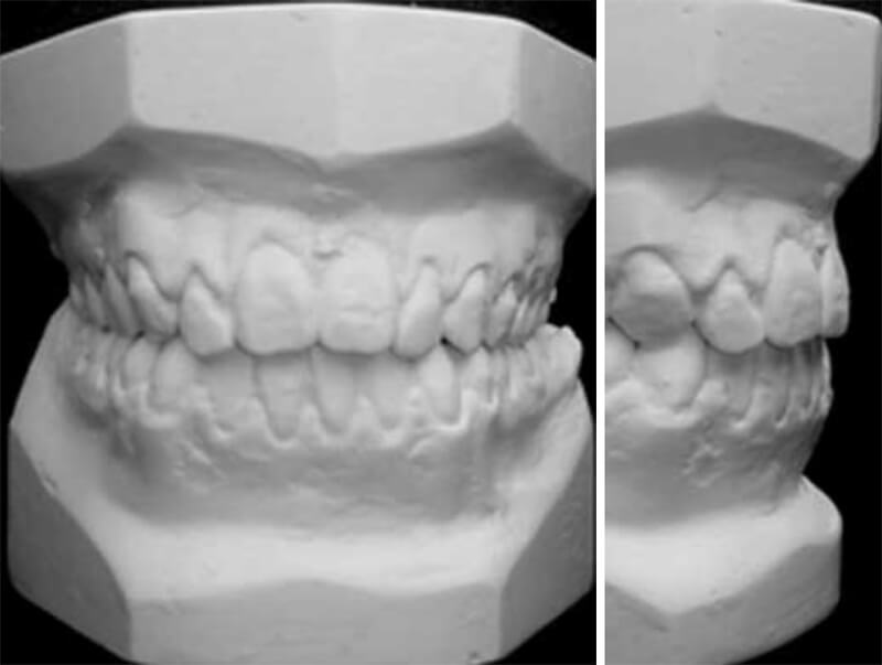 Fig. 17 Modelos de estudio final / Fig. 18 Sobremordida