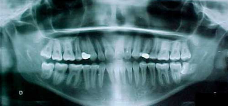 Fig. 20 Radiografía panorámica final. Se observa contacto en todas las piezas dentarias.
