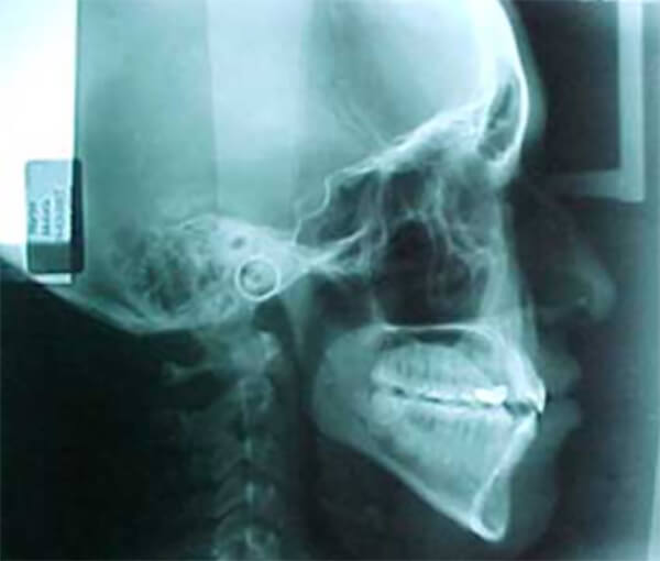 Fig. 21 Radiografía cefálica lateral final
