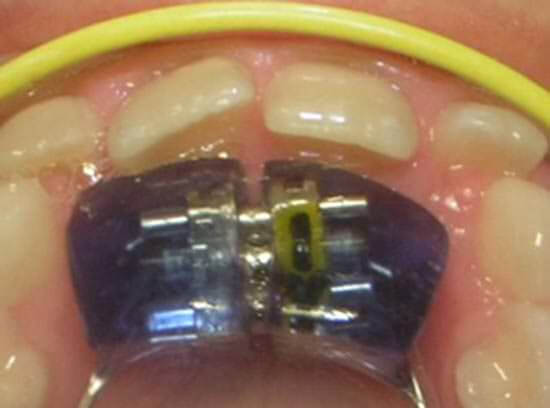 Fig. 1 Plano inclinado de acrílico con tornillo de expansión incorporado.