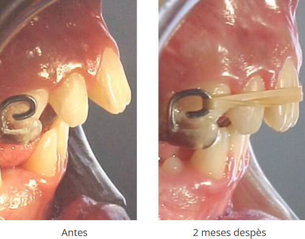 Fig. 2 Ganchos para la colocación de elásticos